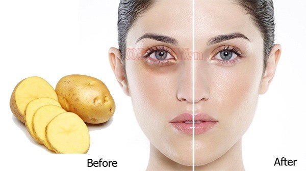 Trong khoai tây có loại enzym catecholase giúp da căng bóng mịn màng, giảm quầng thâm mắt nhanh chóng