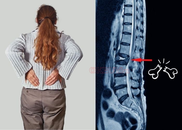 Gãy xương nén làm tăng cơn đau lưng dưới mãn tính