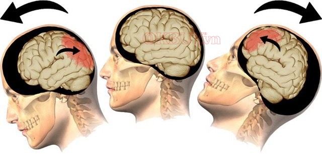 Triệu chứng chấn thương sọ não có thể gây ra đau nhức vùng lưng trầm trọng