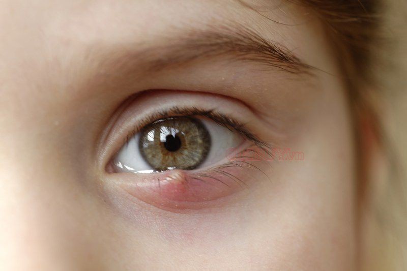 Mụn rộp có thể gây ảnh hưởng rất lớn đến mí mắt