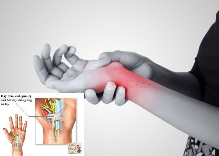 Bệnh quấn cổ tay quay gây đau nhức cổ vai gáy lan xuống cánh tay