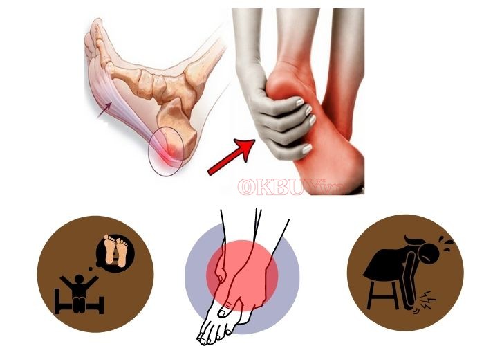 Viêm cân gan chân có thể khiến chân đau nhói âm ỉ và và có thể gây ra nhiều căn bệnh nguy hiểm