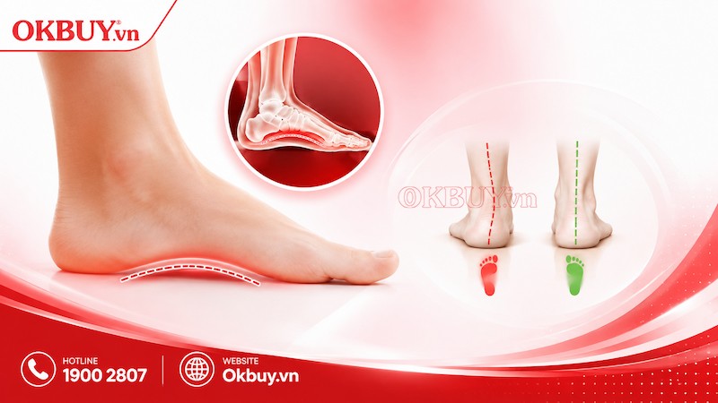 Bàn chân bẹt gây đau nhức lòng bàn chân khi đứng và di chuyển