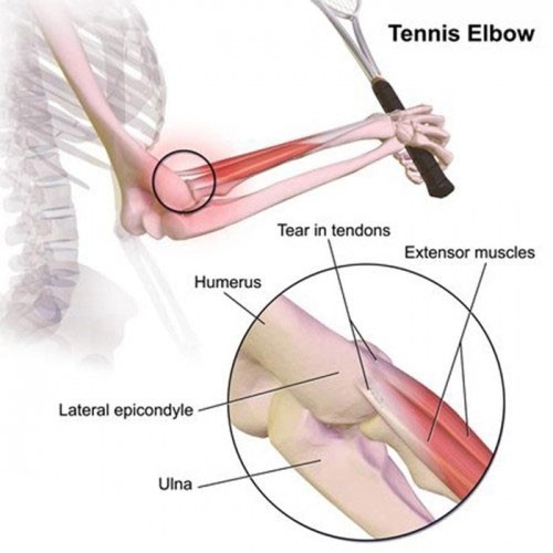 Đai bó cơ khuỷu tay Tennis Elbow