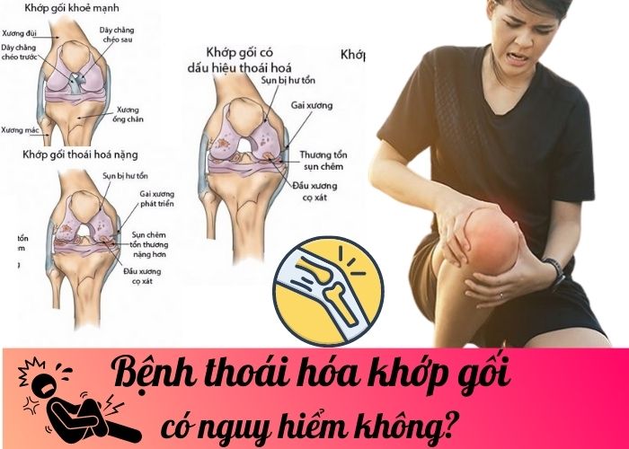 Bệnh thoái hóa khớp gối có nguy hiểm không? 