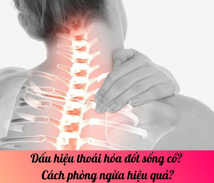 Dấu hiệu thoái hóa đốt sống cổ? Cách phòng ngừa hiệu quả?