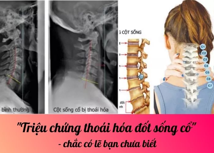 Triệu chứng thoái hóa đốt sống cổ - chắc có lẽ bạn chưa biết