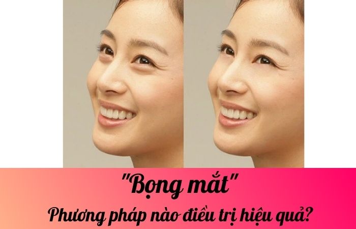 Bọng mắt: Phương pháp nào điều trị hiệu quả?