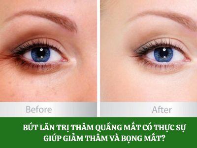 Bút lăn trị thâm quầng mắt có thực sự giúp giảm thâm và bọng mắt?