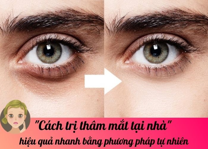 Cách trị thâm mắt tại nhà hiệu quả nhanh bằng phương pháp tự nhiên