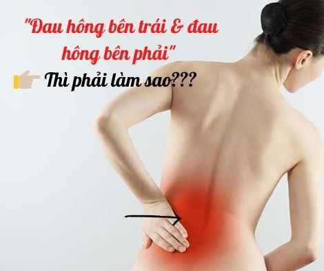 Thỉnh thoảng đau hông bên trái, đau hông bên phải thì phải làm sao? 