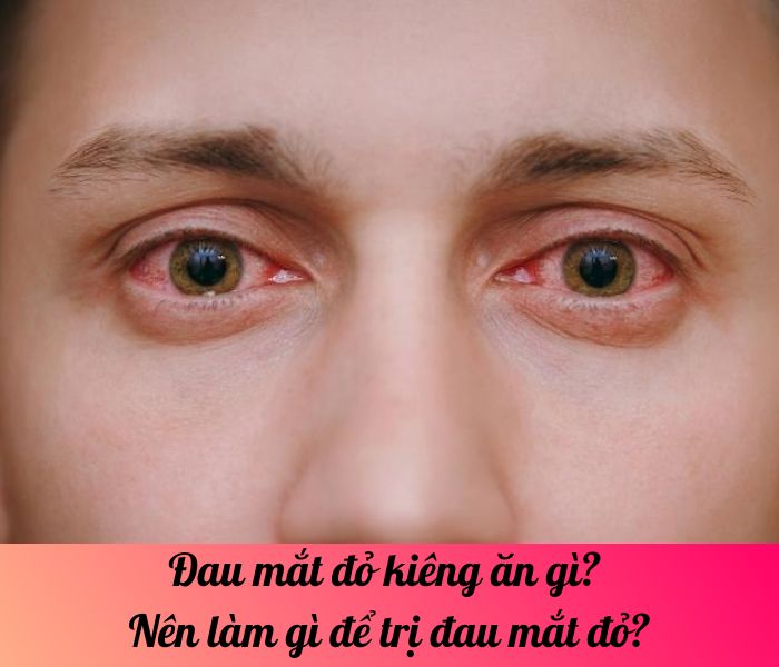 Đau mắt đỏ kiêng ăn gì? Nên làm gì để trị đau mắt đỏ?
