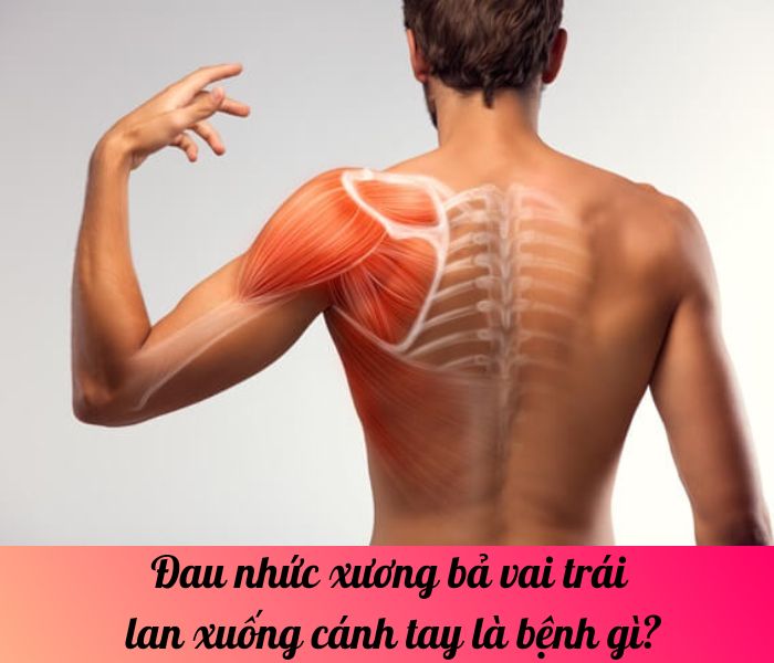 Đau nhức xương bả vai trái lan xuống cánh tay là bệnh gì?