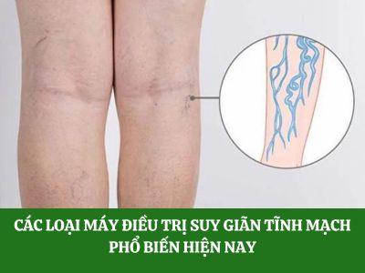 Các loại máy điều trị suy giãn tĩnh mạch phổ biến hiện nay