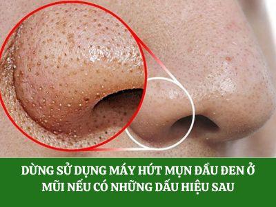 Dừng sử dụng máy hút mụn đầu đen ở mũi nếu có những dấu hiệu sau