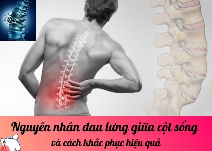 Nguyên nhân đau lưng giữa cột sống và cách khắc phục hiệu quả