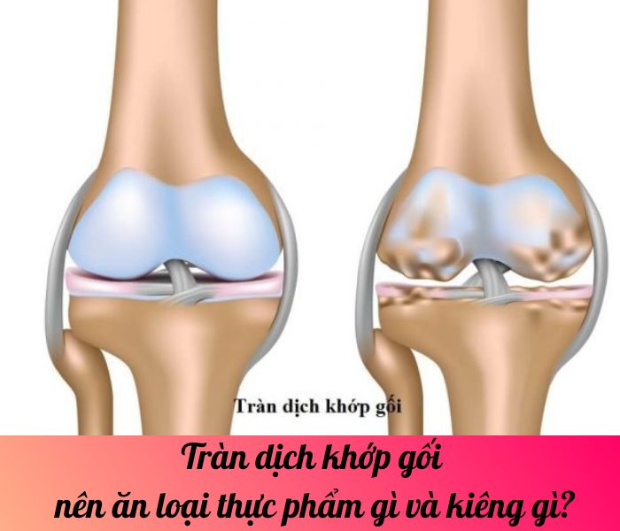 Tràn dịch khớp gối nên ăn loại thực phẩm gì và kiêng gì?