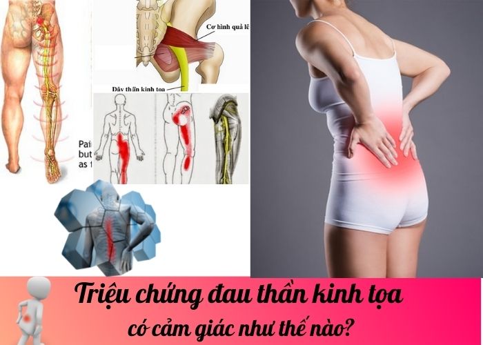 Triệu chứng đau thần kinh tọa có cảm giác như thế nào?