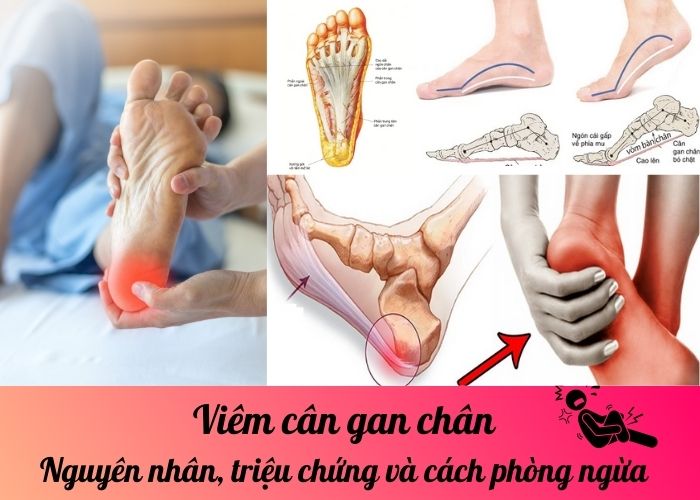 Viêm cân gan chân: Nguyên nhân, triệu chứng và cách phòng ngừa