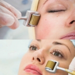 Cây lăn kim điều trị thâm nám