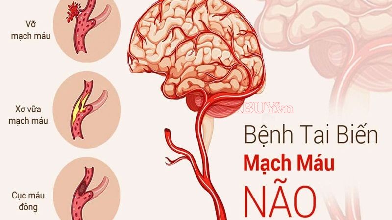 Ăn tỏi đen thường xuyên giúp ngăn ngừa tình trạng tai biến mạch máu não