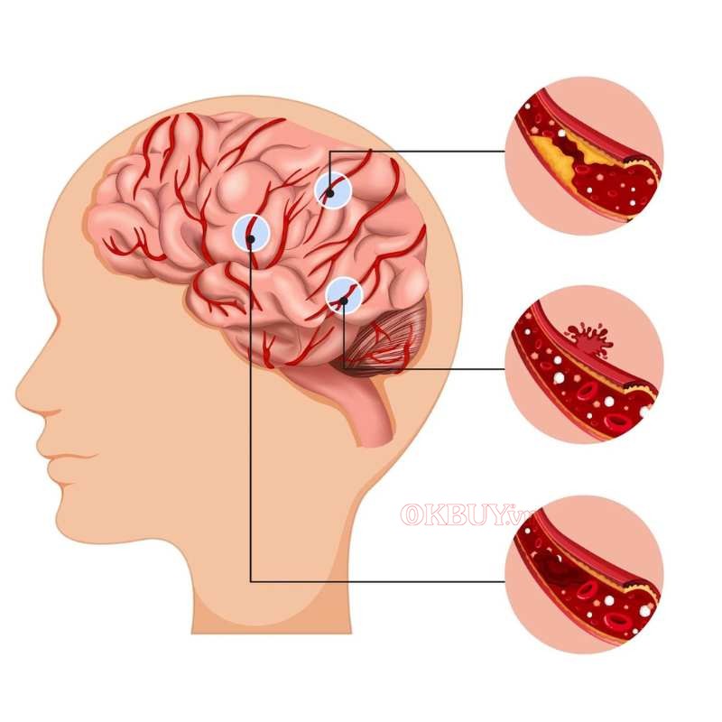 Dòng máu di chuyển đến vùng não bị ngắt quãng