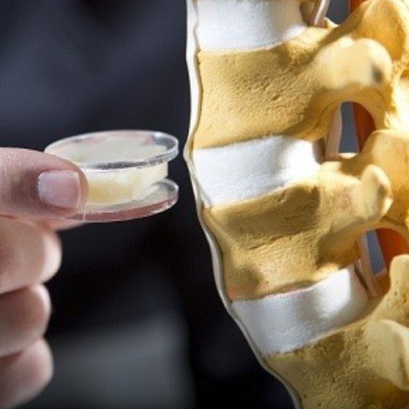Phẫu thuật thay đĩa đệm nhân tạo