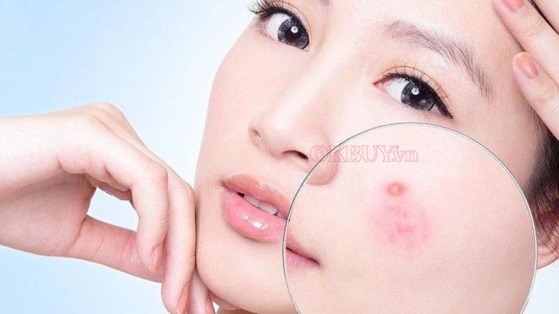 Mụn trứng cá thường xuất hiện nhiều ở vùng mặt