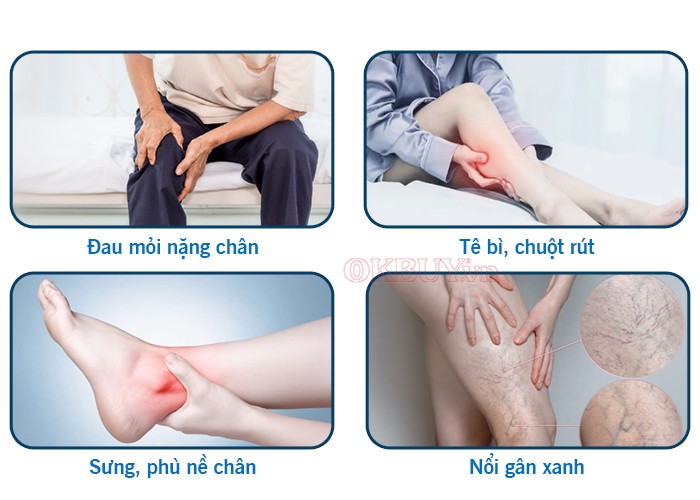 Các biểu hiện của suy giãn tĩnh mạch chân